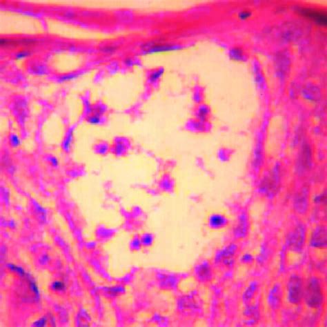 Large atypical lymphoid cells with cerebriform nuclei aggregating in ...