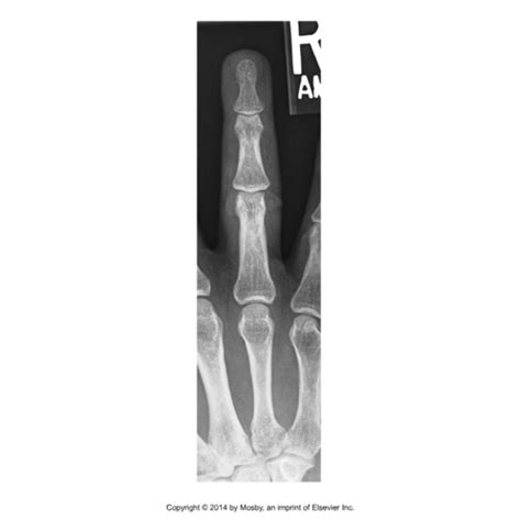 Finger and Thumb X-ray Pictures Flashcards | Quizlet