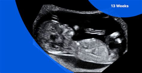 Ultrasound Pictures Of Baby Boy 18 Weeks - Infoupdate.org