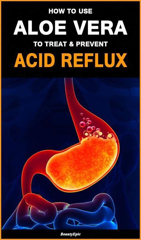 Pin On Treating Acid Reflux Naturally