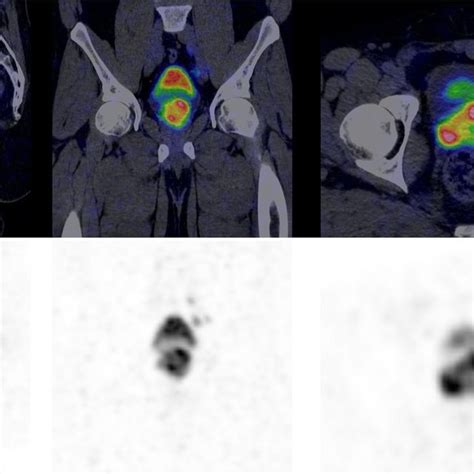 Yellow Arrows Point To A Hilar PSMA Negative LN At 1 H P I SUVmax