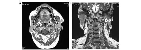 Parotid Gland Tumor Mri