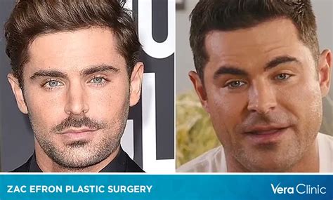 Zac Efron Plastic Surgery: A Closer Look At All The Possibilities