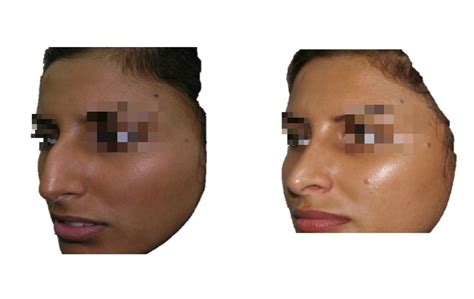 The Dorsal Hump Rhinoplasty Archive