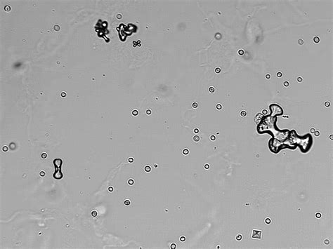 Calcium Oxalate Calcium Crystals Renal Calculi