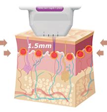 Ultraskin Ii Hifu Nowej Generacji