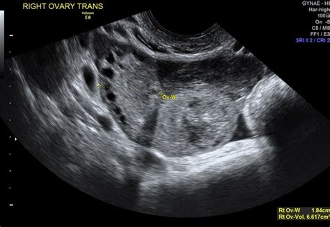 Ectopic Pregnancy Transvaginal Ultrasound