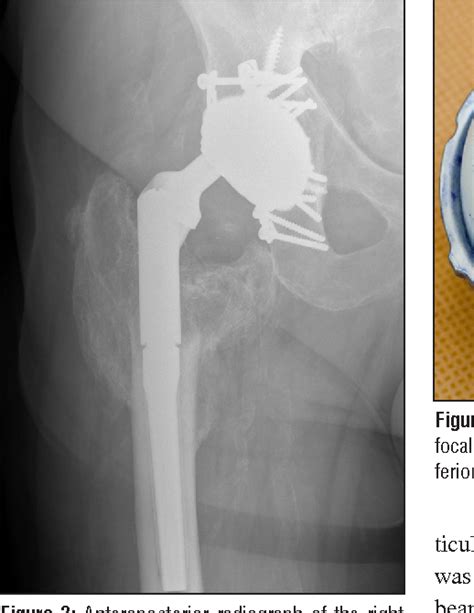 Figure From Intraprosthetic Dislocation Of A Contemporary Dual