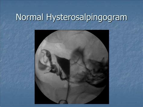 Ppt Hysterosalpingography Powerpoint Presentation Id 308194