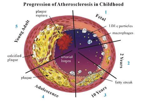 Atherosclerosis Diagram