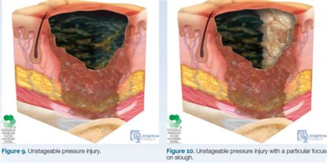 Pressure Ulcers Flashcards Quizlet