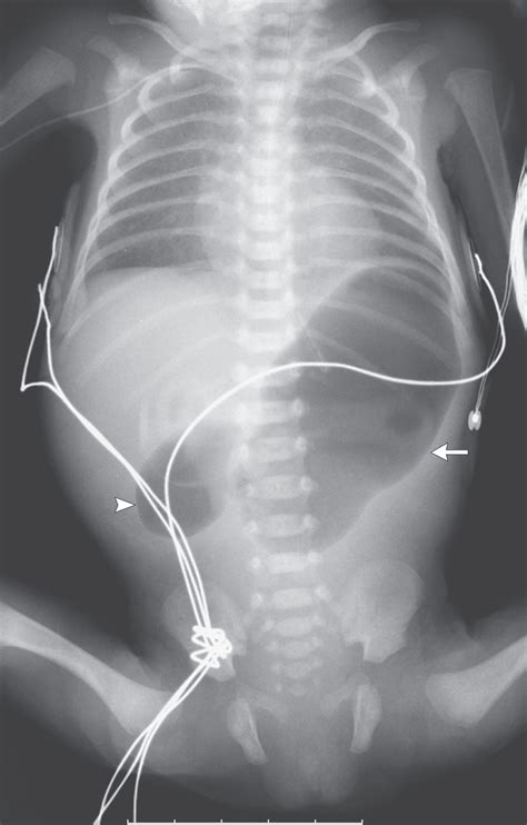 Double Bubble Duodenal Atresia