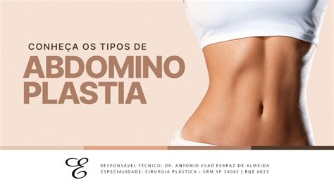 Voc Conhece Os Principais Tipos De Abdominoplastia Dr Esa