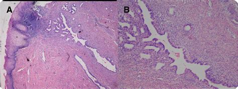 Cervical Endometriosis Clinical Character And Management Experience In