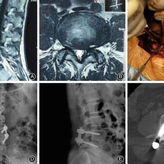 A Year Old Male Patient With A Complaint Of Severe Lower Back Pain