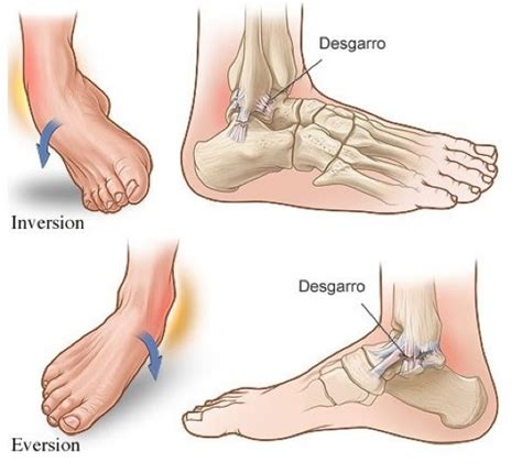 Causas Del Esguince De Tobillo Sintomas Y Tratamiento Fisiolution Images