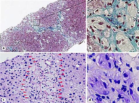 Microscopic Findings Of Liver Biopsy Specimen A B Gaucher Cells In