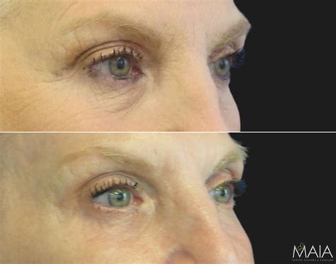 Washington Dc Lower Blepharoplasty Under Eye Bag Removal Before And After Pictures Tysons Corner