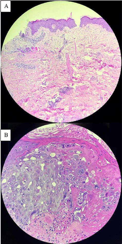 Punch Biopsy Obtained From The Periphery Of The Forearm Lesion Shows