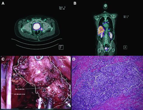 Ab Prostate Specific Membrane Antigen Positron Emission Tomography