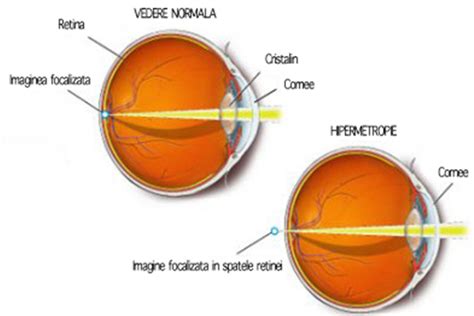 Hipermetropia Vicii De Refractie Consultatii Gratuite Ochelari