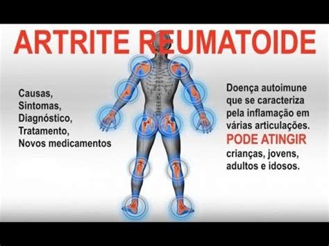 ARTRITE REUMATOIDE Tratamento De Fisioterapia Terapia Manual