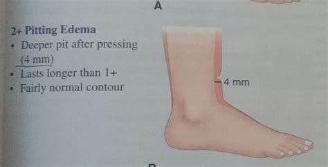 Pitting Edema Scale Grading Assessment For Nurses 50 OFF