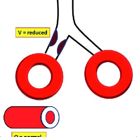 The Mechanism Of Hypoxic Pulmonary Vasoconstriction Hypoxia Causes