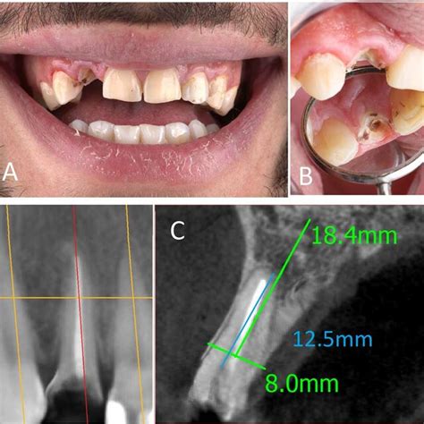 A Preoperative Frontal View B Preoperative Occlusal View C Download Scientific Diagram