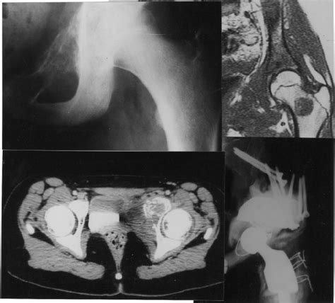 Ewings Sarcoma Of Pelvic Rami With Skip Metastases On The Femoral