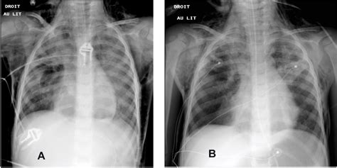 Respiratory Support By Neurally Adjusted Ventilatory Assist Nava In