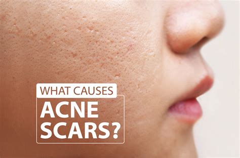 What causes acne scars?