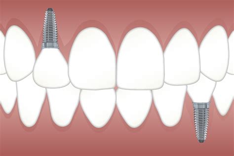 Cost Of Dental Implants In Chennai Dental Implant Chennai M2M Dental