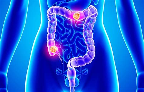 Streptococcus Gallolyticus Promotes Colon Cancer Microbiology