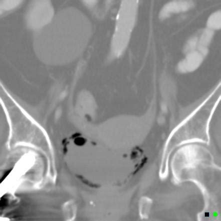 Emphysematous Cystitis Radiology Case Radiopaedia Org