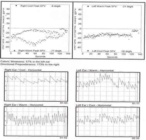 Vestibular Neuritis Acute Clinical Picture