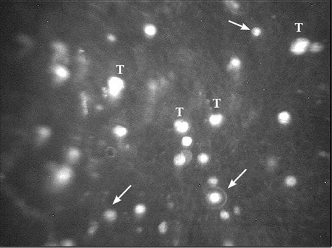 Figure 1 From Various Confocal Scan Features Of Cysts And Trophozoites In Cases With