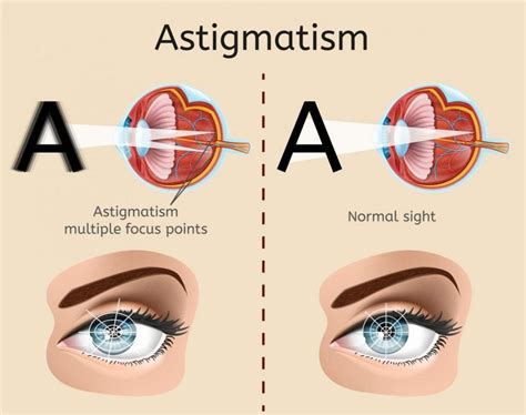 Frequently Asked Questions About Diplopia Or Double Vision Facty Health