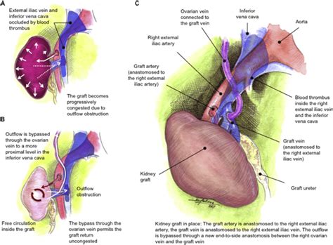 Schematic drawing depicts the steps of gonadal vein utilization to... | Download Scientific Diagram