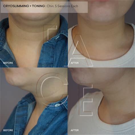 Cryoskin Double Chin Get A Dreamy Jawline With Cryotherapy — Face