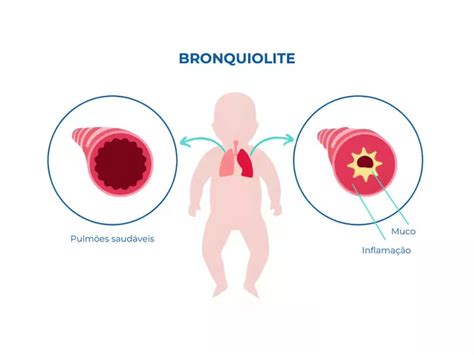 O Que Bronquiolite Em Bebe