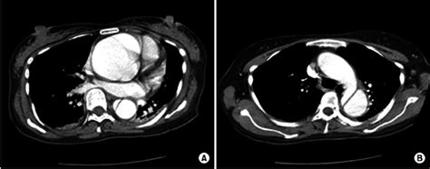 Computed tomography. (A) Huge dilatation of the aortic root with ...