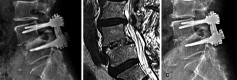 At Months Follow Up Radiograph A And Mri B Didnt Achieved Bony