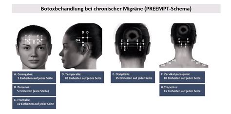 Botox gegen Migräne