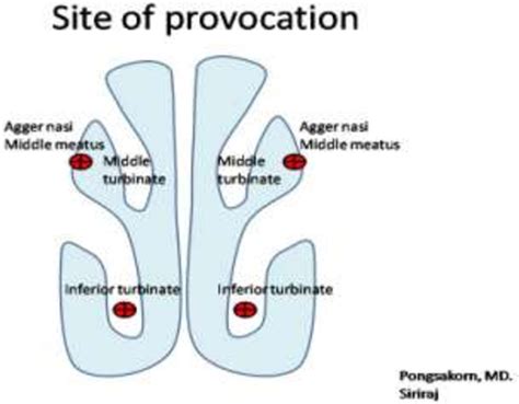 [pdf] Nasal Provocation Test How To Maximize Its Clinical Use