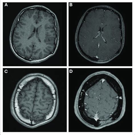 Ac Axial T1 Mr Images Before Contrast Administration Bd Post