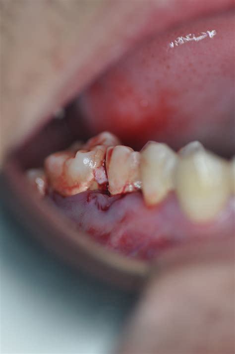 Dentoalveolar Fracture A Complication Of Extraction Of Upper Left First Molar Tay 2018