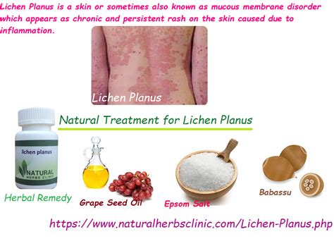 Natural Treatment Of Lichen Planus Natural Herbs Clinic