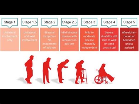 Hoehn And Yahr Scale Made Easy Youtube