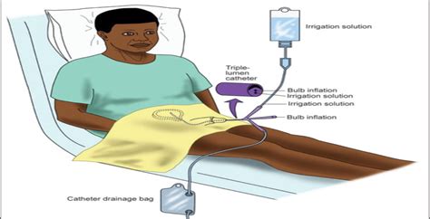 bladder irrigation - DarmanX Academy